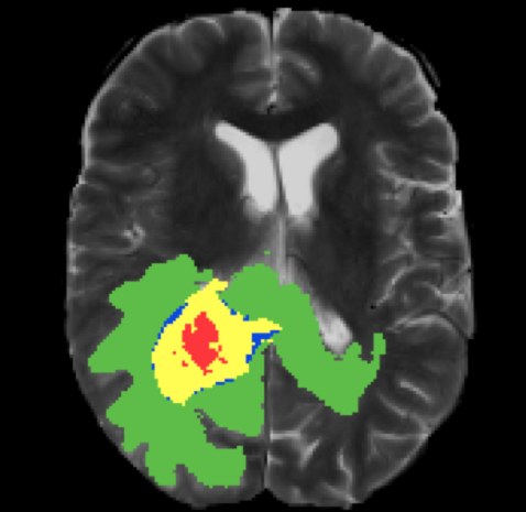 Deep learning for brain tumor segmentation